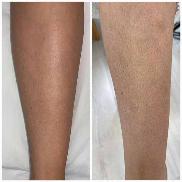 bautifulaura_kosmetik_haarentfernung_muenchen-14