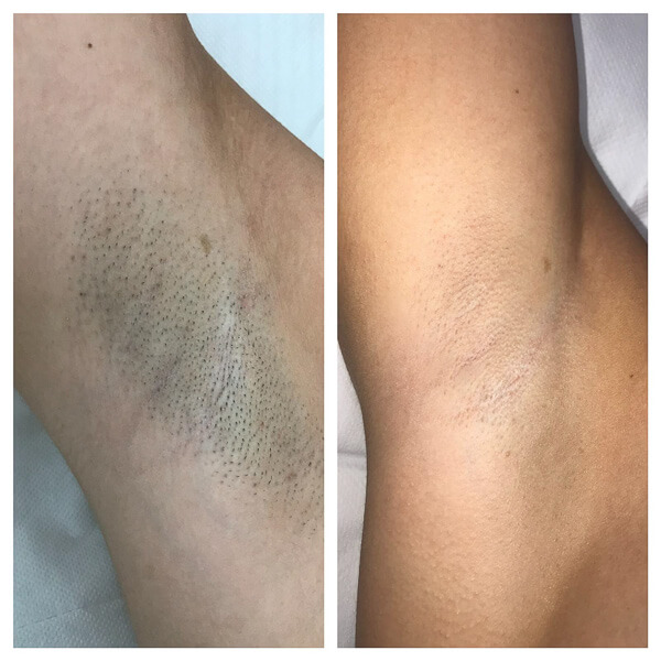 bautifulaura_kosmetik_haarentfernung_muenchen-17